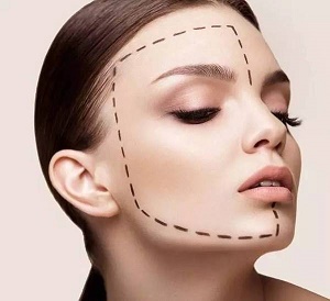 自体脂肪丰眉弓