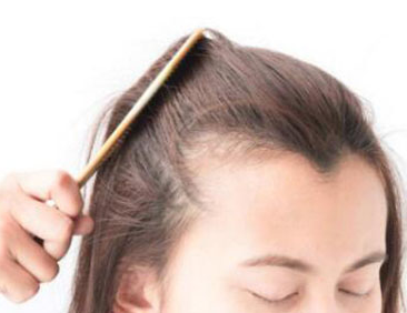 脱发际线