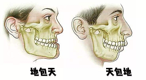下颚前突/地包天